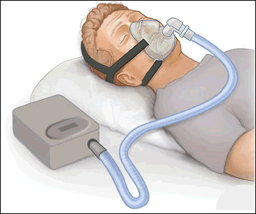 CPAP